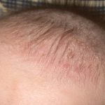 cradle-cap-in-infants