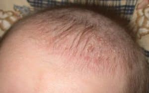 cradle-cap-in-infants