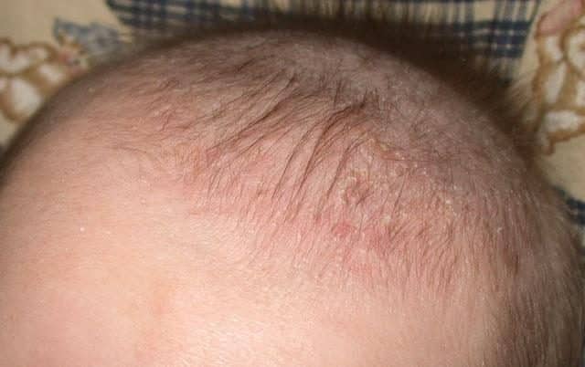 cradle-cap-in-infants