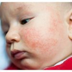 cream for eczema, infant eczema cream, signs of eczema in infants, treating eczema, snail cream for eczema, eczema causes, treat infant eczema