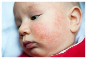 cream for eczema, infant eczema cream, signs of eczema in infants, treating eczema, snail cream for eczema, eczema causes, treat infant eczema