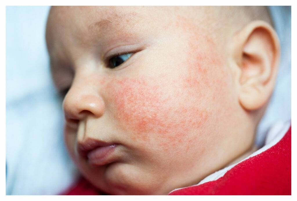 cream for eczema, infant eczema cream, signs of eczema in infants, treating eczema, snail cream for eczema, eczema causes, treat infant eczema