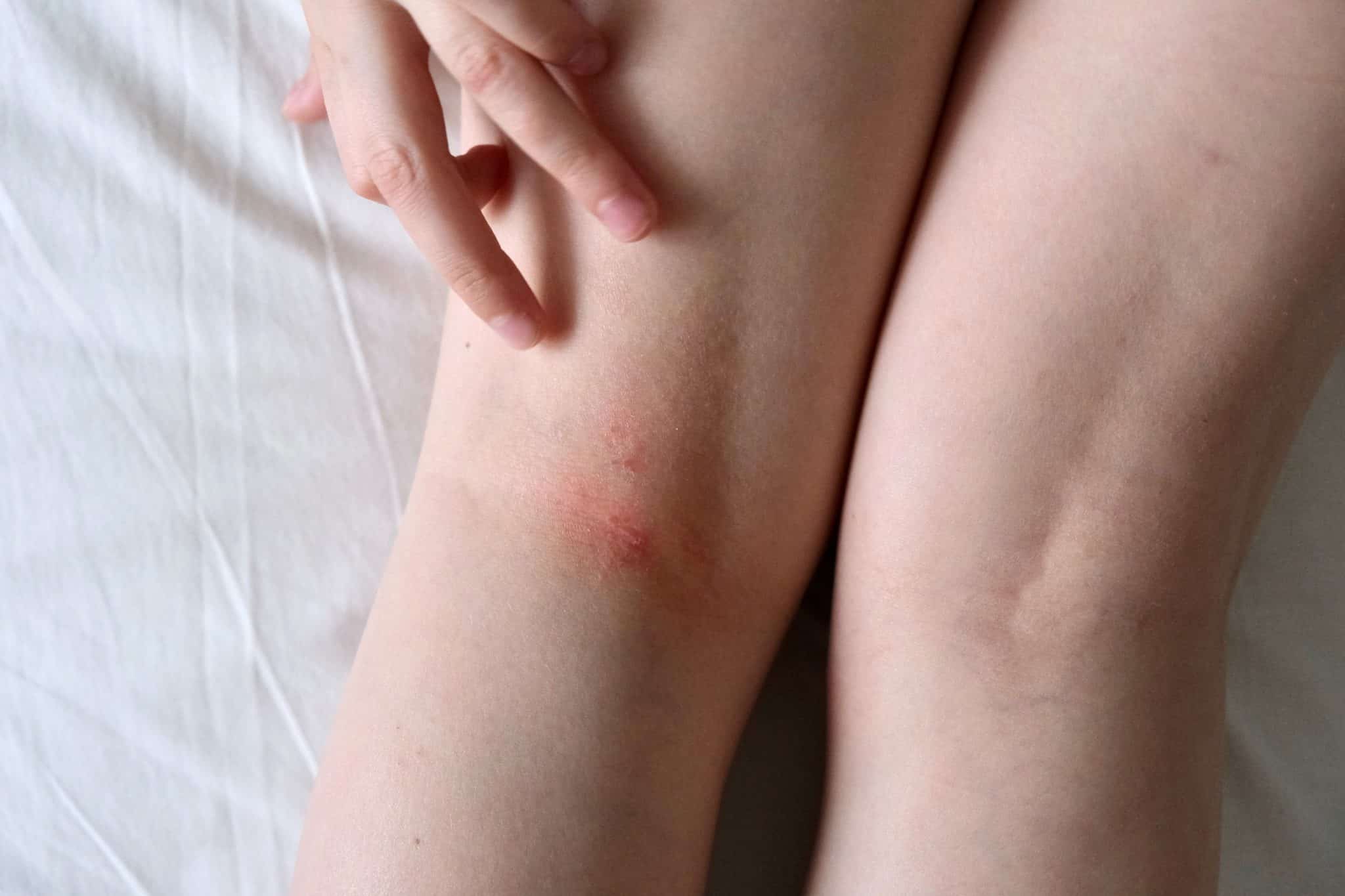 contact dermatitis, cream for insect bites