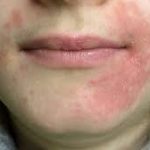 seborrheic dermatitis on face, what causes eczema in adults, Perioral Dermatitis