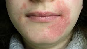 seborrheic dermatitis on face, what causes eczema in adults, Perioral Dermatitis
