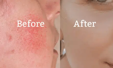 Before and after comparison showing improvement in skin affected by atopic dermatitis