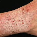 neurodermatitis eczema,
