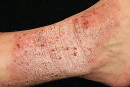 neurodermatitis eczema,