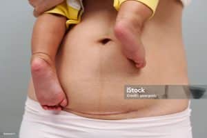 C SECTION SCAR, C-SECTION SCARRING,