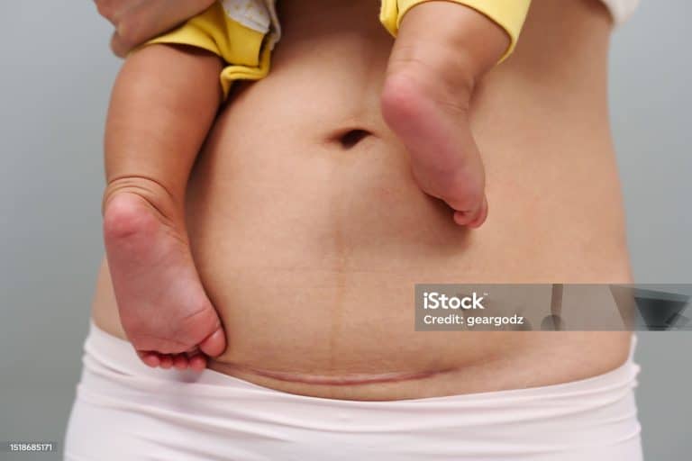 C SECTION SCAR, C-SECTION SCARRING,