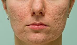 ice pick scars,