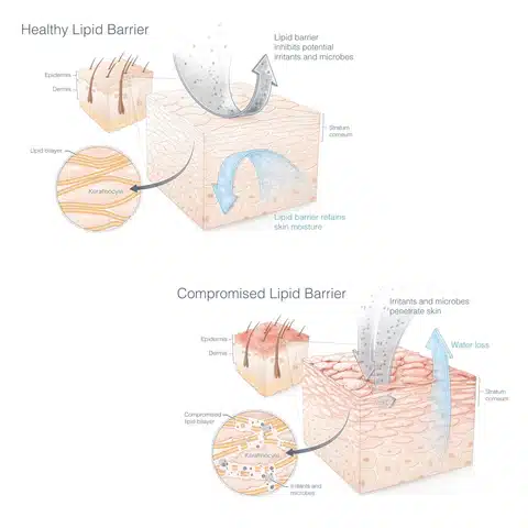 diagram of compromised skin barrier,