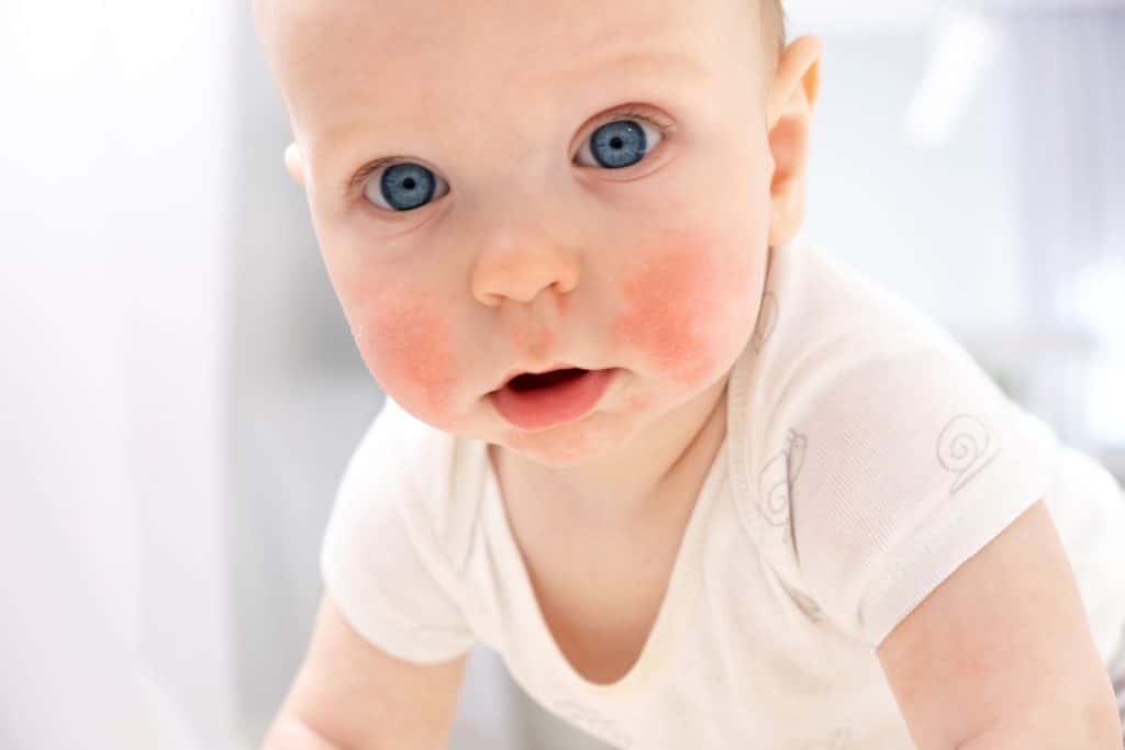 signs of rczema in infants, Newborn eczema cream,