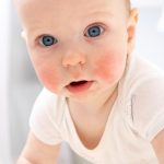 baby eczema, baby eczema cream, baby eczema treatment, baby eczema rash, baby eczema symptoms, eczema relief cream, infant eczema, signs of eczema in infants, Newborn eczema cream, best cream for eczema, eczema cream ireland, gentle cream for eczema, eczema relief cream, best eczema lotion ireland,