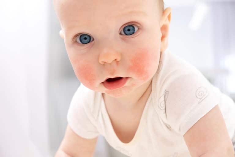 ​baby eczema, baby eczema cream, baby eczema treatment, baby eczema rash, baby eczema symptoms, eczema relief cream, infant eczema, signs of eczema in infants, Newborn eczema cream, ​best cream for eczema, eczema cream ireland, gentle cream for eczema, eczema relief cream, best eczema lotion ireland,