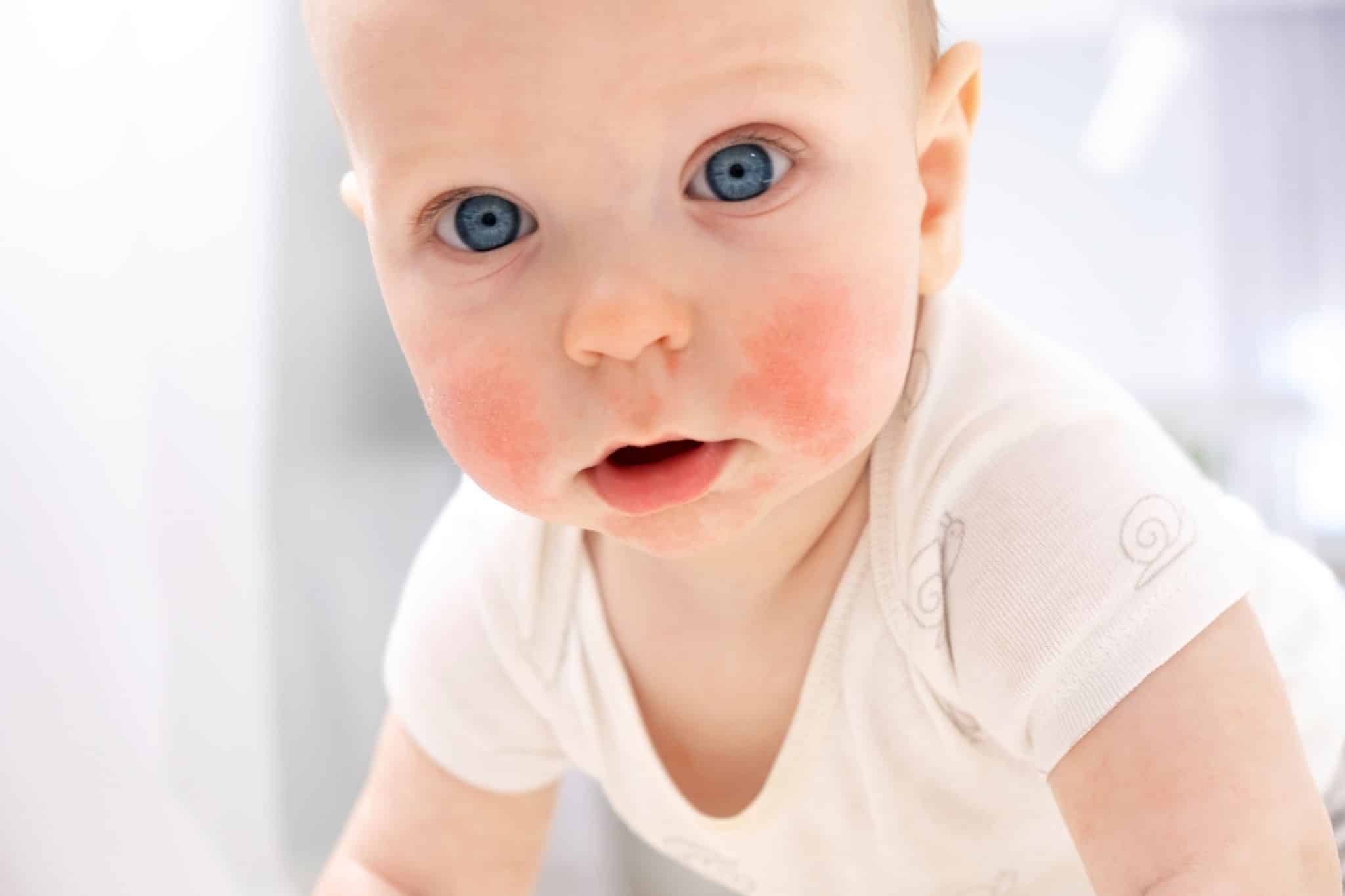 ​baby eczema, baby eczema cream, baby eczema treatment, baby eczema rash, baby eczema symptoms, eczema relief cream, infant eczema, signs of eczema in infants, Newborn eczema cream, ​best cream for eczema, eczema cream ireland, gentle cream for eczema, eczema relief cream, best eczema lotion ireland,