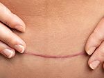 tummy tuck scarring, C SECTION SCAR,