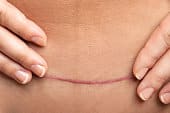 tummy tuck scarring, C SECTION SCAR,