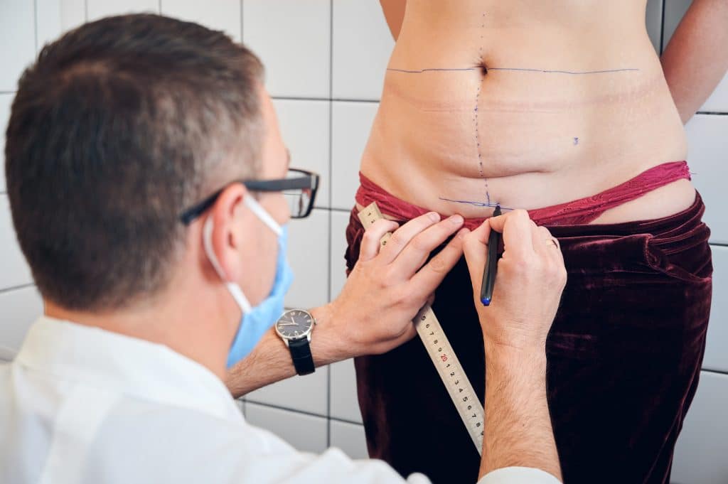 tummy tuck scar, tummy tuck scarring,