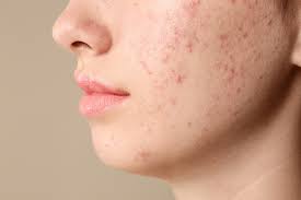 ice pick scars,