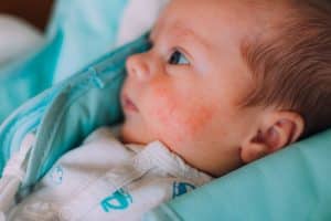 ingant eczema, seborrheic dermatitis face cream, newborn eczema cream,