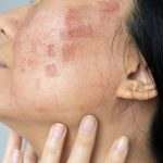 what causes ezcema, discoid eczema, nummular dermatitis