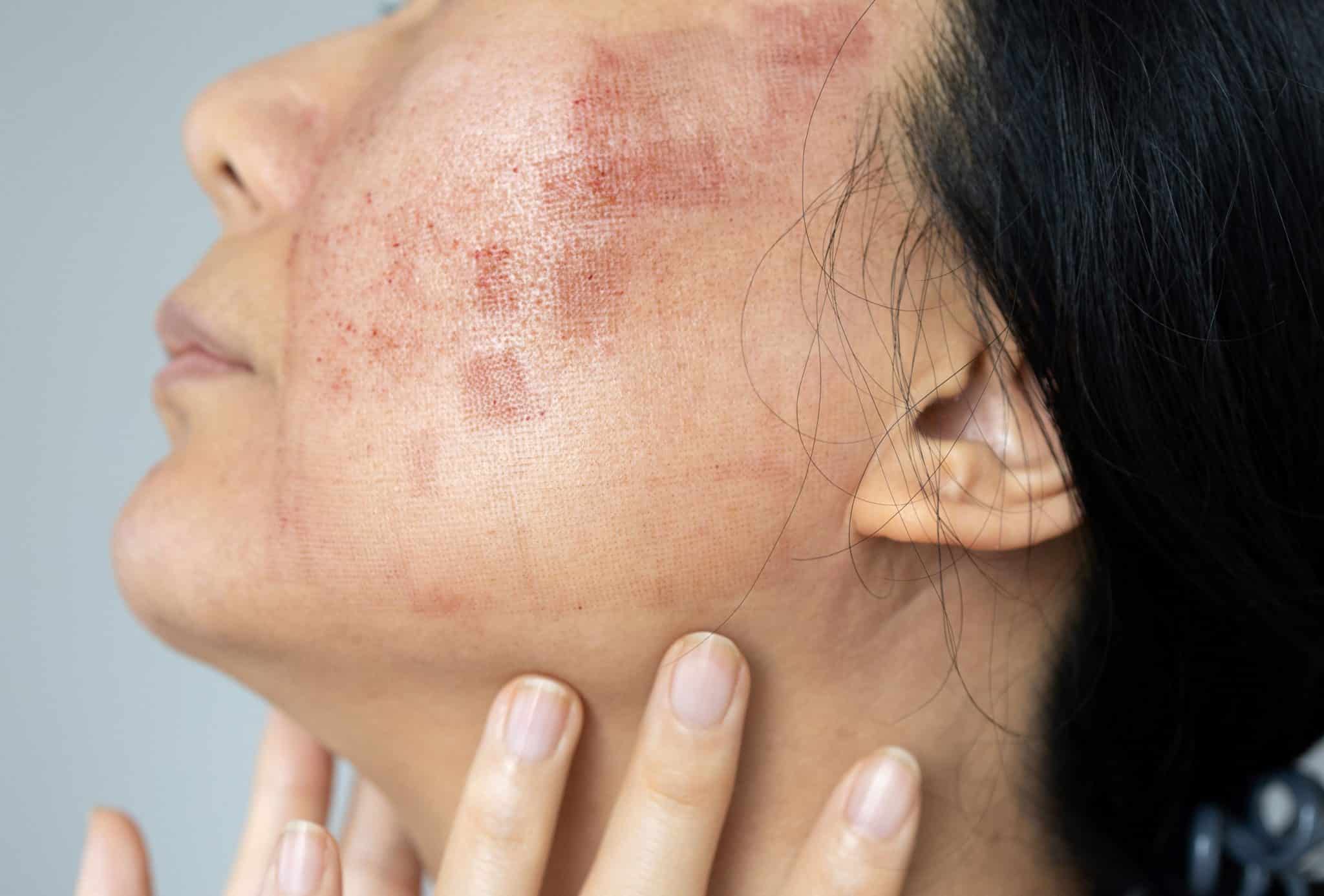 what causes ezcema, discoid eczema, nummular dermatitis