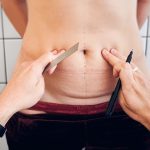 tummy tuck scar, tummy tuck scarring,