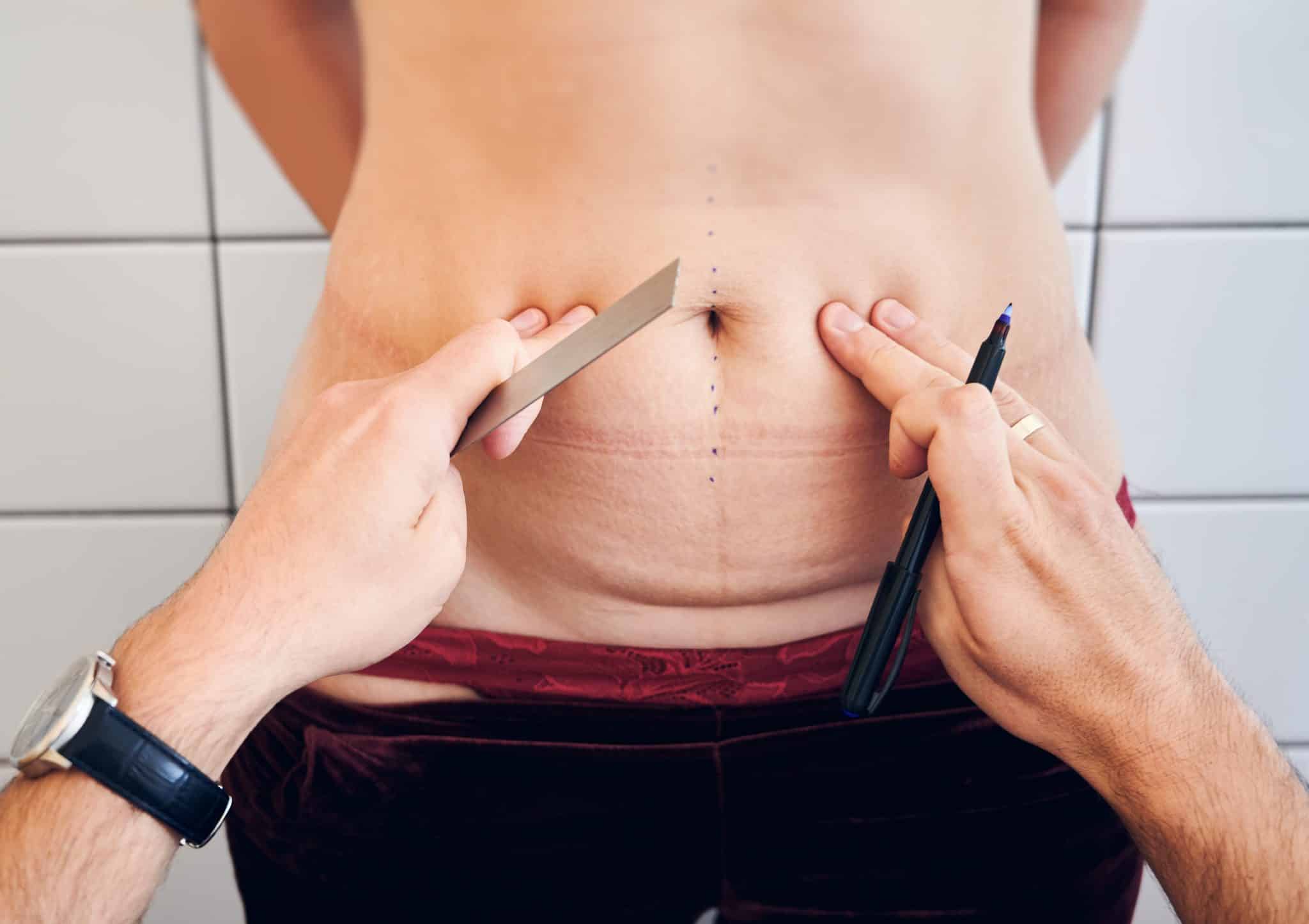 tummy tuck scar, tummy tuck scarring,