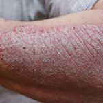 best cream for psoriasis, psoriasis treatment cream,