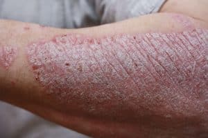 best cream for psoriasis, psoriasis treatment cream,