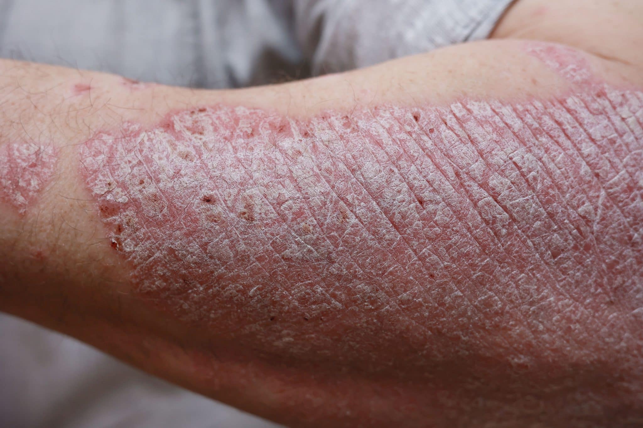 best cream for psoriasis, psoriasis treatment cream,