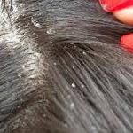 Shampoo for Seborrhoeic Dermatitis, understanding seborrheic dermatitis, Best Scalp Treatment for Seborrheic Dermatitis:, Dermatitis Seborreica Treatment, shampoo for seborrheic dermatitis, seborrheic dermatitis scalp, Seborrheic Dermatitis Treatment, treat seborrheic dermatitis, Gentle shampoo for sensitive scalp., Seborrhoeic psoriasis