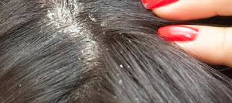 Shampoo for Seborrhoeic Dermatitis, understanding seborrheic dermatitis, Best Scalp Treatment for Seborrheic Dermatitis:, Dermatitis Seborreica Treatment, shampoo for seborrheic dermatitis, seborrheic dermatitis scalp, Seborrheic Dermatitis Treatment, treat seborrheic dermatitis, Gentle shampoo for sensitive scalp., Seborrhoeic psoriasis