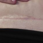 tummy tuck scarr, How to Treat Scars on the Face, Best Snail Cream for Scars, how to det rid of scars,
