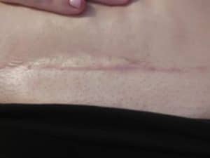 tummy tuck scarr, How to Treat Scars on the Face, Best Snail Cream for Scars, how to det rid of scars,