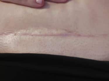tummy tuck scarr, How to Treat Scars on the Face, Best Snail Cream for Scars, how to det rid of scars,