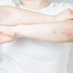 atopic dermatitis cream, allergic reaction rash, how to treat atopic dermatitis, Psoriatic Arthritis Cream