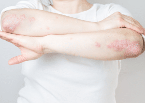 atopic dermatitis cream, allergic reaction rash, how to treat atopic dermatitis, Psoriatic Arthritis Cream