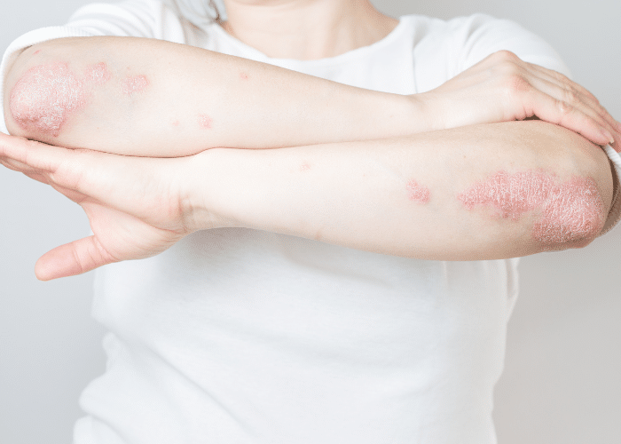 atopic dermatitis cream, allergic reaction rash, how to treat atopic dermatitis, Psoriatic Arthritis Cream