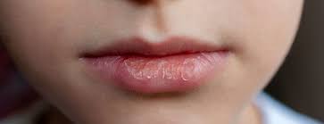 severely dried lips,