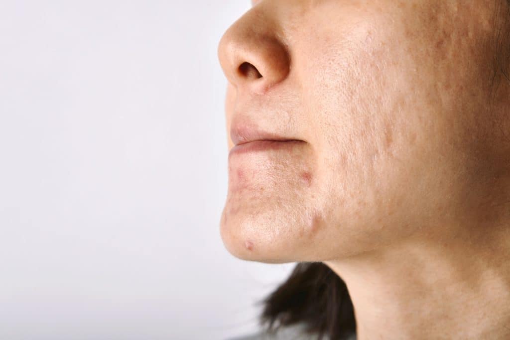 ​acne cream, best acne cream ireland, acne treatment cream, affordable acne cream, acne cream for sensitive skin, best snail cream for acne,