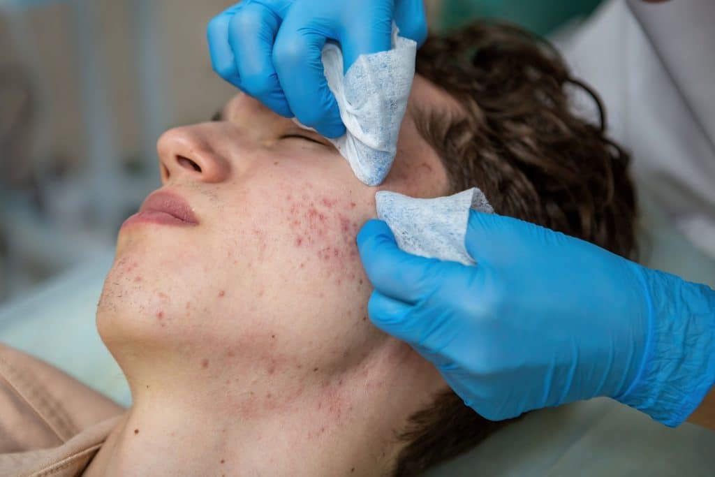 ​snail cream for acne, best snail cream for acne ireland, snail mucin cream acne treatment, natural acne cream with snail, affordable snail cream acne care ireland, best snail cream for acne,
