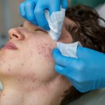 best snail cream for acne,