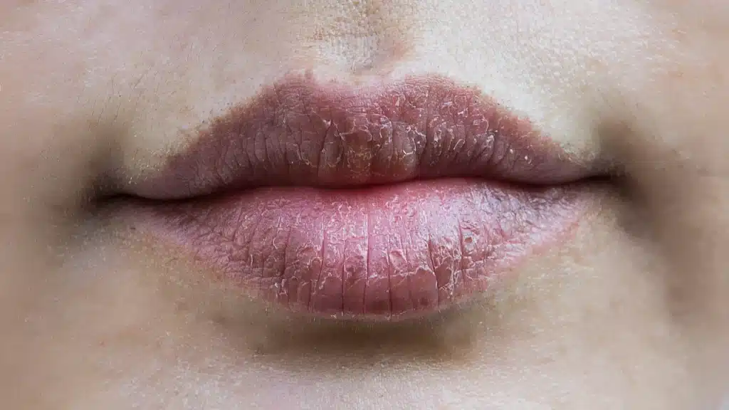 lip care, beat lip baln, chapped lips, dry lips,