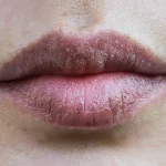 dry chapped lips, lip care, beat lip baln, chapped lips, dry lips,