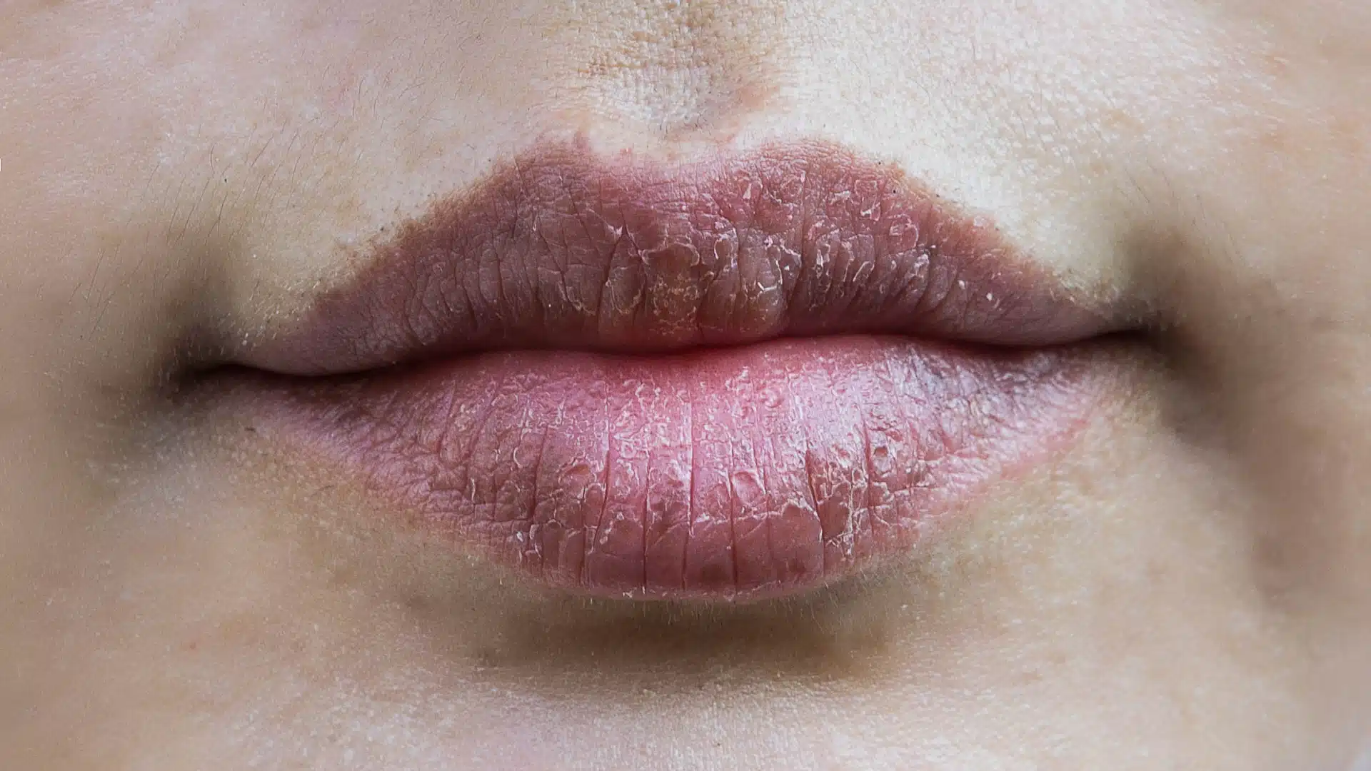 dry chapped lips, lip care, beat lip baln, chapped lips, dry lips,