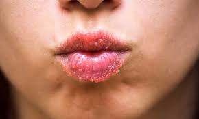 chapped lips, dry lips,