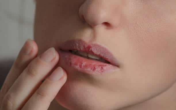 remedy for cracked lips, lip balm,dry lips, chapped lips,