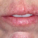 remedy for cracked lips, dry chapped lips,